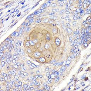 Immunohistochemistry analysis of paraffin-embedded human esophageal cancer using Anti-FGFR3 Antibody [ARC0398] (A307337) at a dilution of 1:100 (40x lens). Perform microwave antigen retrieval with 10 mM PBS buffer pH 7.2 before commencing with IHC staining protocol.