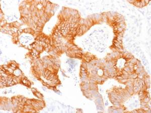 Immunohistochemical analysis of formalin-fixed, paraffin-embedded human colorectal carcinoma using Anti-EpCAM Antibody [EGP40/1798]