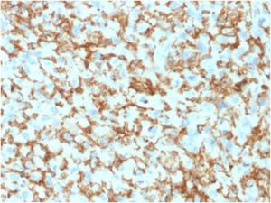 Immunohistochemical analysis of formalin-fixed, paraffin-embedded human histiocytoma using Anti-CD163 Antibody [M130/1210]