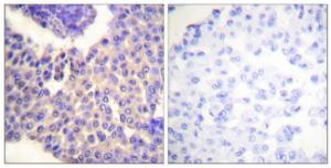 Immunohistochemical analysis of paraffin-embedded human breast carcinoma using Anti-Arrestin 1 (phospho Ser412) Antibody. The right hand panel represents a negative control, where the antibody was pre-incubated with the immunising peptide