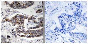 Immunohistochemical analysis of paraffin-embedded human breast carcinoma using Anti-Girdin (phospho Ser1417) Antibody The right hand panel represents a negative control, where the antibody was pre-incubated with the immunising peptide