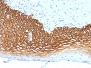 Immunohistochemical analysis of formalin-fixed, paraffin-embedded human cervix carcinoma using Anti-CD44v3 Antibody [3G5]