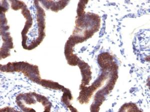 Immunohistochemical analysis of formalin-fixed, paraffin-embedded human ovarian carcinoma using Anti-EpCAM Antibody [EGP40/1120]