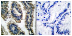 Immunohistochemical analysis of paraffin-embedded human lung carcinoma using Anti-STAT2 (phospho Tyr690) Antibody. The right hand panel represents a negative control, where the antibody was pre-incubated with the immunising peptide.