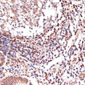 Immunohistochemistry analysis of paraffin-embedded human appendix tissue using Anti-5 Lipoxygenase/5-LO Antibody [ARC1926] (A14230) at a dilution of 1:100 (40X lens). Perform microwave antigen retrieval with 10 mM Tris/EDTA buffer pH 9.0 before commencing with IHC staining protocol