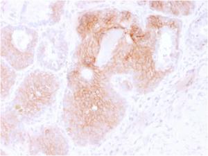 Immunohistochemical analysis of formalin-fixed, paraffin-embedded human prostate carcinoma using Anti-CD44v6 Antibody [CD44V6/2496]