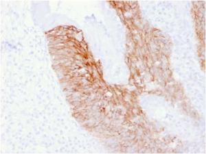 Immunohistochemical analysis of formalin-fixed, paraffin-embedded human cervix carcinoma using Anti-CD44v6 Antibody [CD44V6/2496]