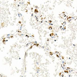 Immunohistochemistry analysis of paraffin-embedded human esophageal cancer using Anti-mtTFA Antibody [ARC51776] (A14389) at a dilution of 1:200 (40x lens) Perform high pressure antigen retrieval with 10 mM citrate buffer pH 60 before commencing with IHC staining protocol