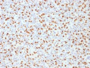 Immunohistochemical analysis of formalin-fixed, paraffin-embedded human Hodgkin's lymphoma using Anti-PU.1 Antibody [PU1/2146]