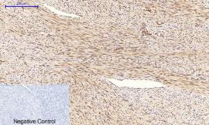 Immunohistochemical analysis of paraffin-embedded human uterus cancer tissue using Anti-Tau (phospho Ser396) Antibody at 1:200 (4 °C overnight). Negative control was secondary Antibody only