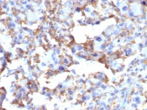 Immunohistochemical analysis of formalin-fixed, paraffin-embedded human histiocytoma using Anti-CD163 Antibody [M130/2163]