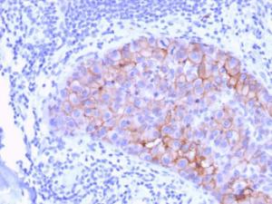 Immunohistochemical analysis of formalin-fixed, paraffin-embedded human breast carcinoma using Anti-HER2 Antibody [ERBB2/3078]