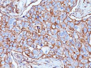 Immunohistochemical analysis of formalin-fixed, paraffin-embedded human breast carcinoma using Anti-CD44 Antibody [156-3C11]