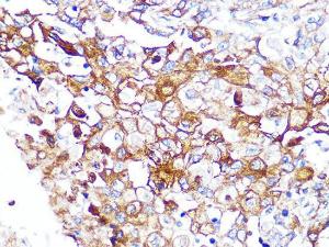 Immunohistochemistry analysis of paraffin-embedded human esophageal cancer using Anti-Caveolin-2 Antibody [ARC0323] (A307368) at a dilution of 1:100 (40x lens). Perform microwave antigen retrieval with 10 mM PBS buffer pH 7.2 before commencing with IHC staining protocol.