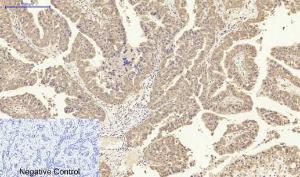 Immunohistochemical analysis of paraffin-embedded human liver cancer tissue using Anti-IL8 Antibody at 1:200 (4°C overnight). Negative control was secondary antibody only.