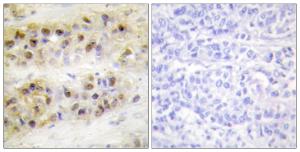 Immunohistochemical analysis of paraffin-embedded human breast carcinoma tissue using Anti-RORA Antibody. The right hand panel represents a negative control, where the antibody was pre-incubated with the immunising peptide