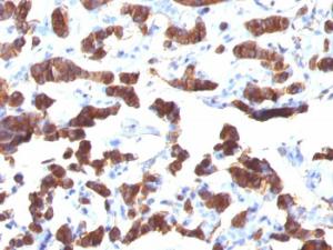 Immunohistochemical analysis of formalin-fixed, paraffin-embedded human thyroid carcinoma using Anti-Thyroglobulin Antibody [TGB24]