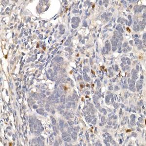 Immunohistochemistry analysis of paraffin-embedded human colon carcinoma tissue using Anti-NUR77 Antibody (A15327) at a dilution of 1:100 (40x lens)