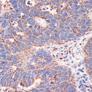 Immunohistochemistry analysis of paraffin-embedded human colon carcinoma tissue using Anti-REA Antibody [ARC1449] (A308350) at a dilution of 1:100 (40x lens). Perform microwave antigen retrieval with 10 mM PBS buffer pH 7.2 before commencing with IHC staining protocol.