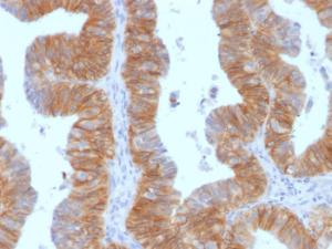 Immunohistochemical analysis of formalin-fixed, paraffin-embedded human ovarian carcinoma using Anti-EpCAM Antibody [EGP40/1384]