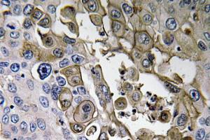 Immunohistochemical analysis of paraffin-embedded human lung carcinoma tissue using Anti-RAGE Antibody