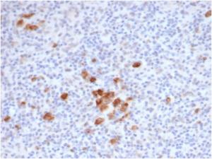 Immunohistochemical analysis of formalin-fixed, paraffin-embedded human Hodgkin's lymphoma using Anti-CD30 Antibody [rKi-1/6913] at 2 µg/ml in PBS for 30 minutes at room temperature