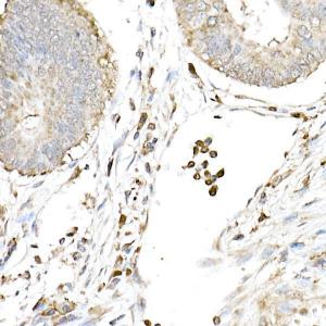 Immunohistochemistry analysis of paraffin-embedded human colon carcinoma tissue using Anti-cGAS Antibody (A16161) at a dilution of 1:50 (40x lens). Perform high pressure antigen retrieval with 10 mM citrate buffer pH 6.0 before commencing with IHC staining protocol.