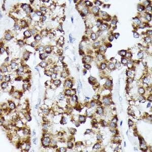 Immunohistochemistry analysis of paraffin-embedded human liver cancer using Anti-CDCA3 Antibody [ARC2135] (A307391) at a dilution of 1:100 (40x lens) Perform microwave antigen retrieval with 10 mM Tris/EDTA buffer pH 90 before commencing with IHC staining protocol