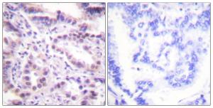 Immunohistochemical analysis of paraffin-embedded human lung carcinoma using Anti-ERF (phospho Thr526) Antibody. The right hand panel represents a negative control, where the antibody was pre-incubated with the immunising peptide.