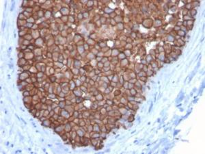 Immunohistochemical analysis of formalin-fixed, paraffin-embedded human breast carcinoma using Anti-HER2 Antibody [ERBB2/3092]