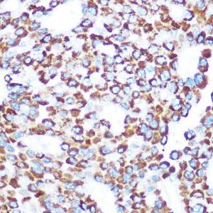 Immunohistochemistry analysis of paraffin-embedded human liver cancer using Anti-TAB3 Antibody (A308359) at a dilution of 1:100 (40x lens). Perform microwave antigen retrieval with 10 mM Tris/EDTA buffer pH 9.0 before commencing with IHC staining protocol.