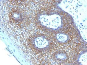 Immunohistochemical analysis of formalin-fixed, paraffin-embedded human cervical squamous cell carcinoma using Anti-CD44v4 Antibody [CD44v4/1219]