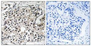 Immunohistochemical analysis of paraffin-embedded human breast carcinoma tissue using Anti-PECI Antibody. The right hand panel represents a negative control, where the antibody was pre-incubated with the immunising peptide.