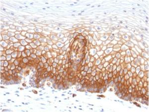 Immunohistochemical analysis of formalin-fixed, paraffin-embedded human cervical carcinoma using Anti-Thrombomodulin Antibody [THBD/1591]