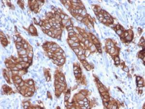 Immunohistochemical analysis of formalin-fixed, paraffin-embedded human breast carcinoma using Anti-HER2 Antibody [ERBB2/3093]