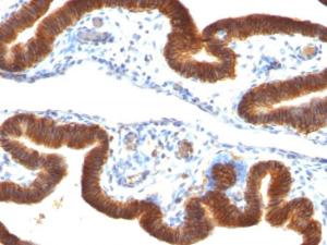 Immunohistochemical analysis of formalin-fixed, paraffin-embedded human ovarian carcinoma using Anti-EpCAM Antibody [SPM134]