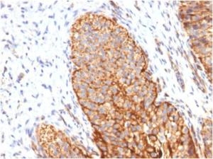 Immunohistochemical analysis of formalin-fixed, paraffin-embedded human bladder carcinoma using Anti-Thrombomodulin Antibody [THBD/1591]