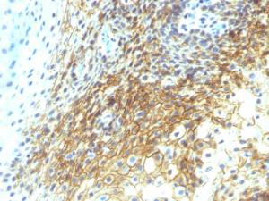 Immunohistochemical analysis of formalin-fixed, paraffin-embedded human tongue squamous cell carcinoma using Anti-CD44v4 Antibody [CD44v4/1219]