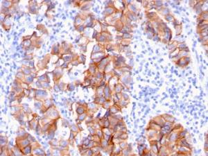 Immunohistochemical analysis of formalin-fixed, paraffin-embedded human breast carcinoma using Anti-HER2 Antibody [ERBB2/3093]