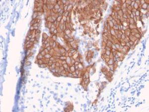 Immunohistochemical analysis of formalin-fixed, paraffin-embedded human breast carcinoma using Anti-HER2 Antibody [ERBB2/3093]