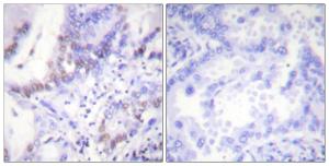 Immunohistochemical analysis of paraffin-embedded human lung carcinoma using Anti-Abl (phospho Tyr412) Antibody. The right hand panel represents a negative control, where the antibody was pre-incubated with the immunising peptide.