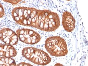 Immunohistochemical analysis of formalin-fixed, paraffin-embedded human colon carcinoma using Anti-EpCAM Antibody [rVU-1D9]