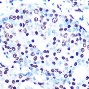 Immunohistochemistry analysis of paraffin-embedded human breast cancer tissue using Anti-SFPQ Antibody [ARC0788] (A307412) at a dilution of 1:100 (40X lens). Perform microwave antigen retrieval with 10 mM PBS buffer pH 7.2 before commencing with IHC staining protocol