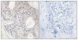 Immunohistochemical analysis of paraffin-embedded human breast carcinoma tissue using Anti-Cytochrome P450 1A2 Antibody. The right hand panel represents a negative control, where the antibody was pre-incubated with the immunising peptide