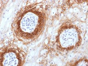 Immunohistochemical analysis of formalin-fixed, paraffin-embedded human tongue carcinoma using Anti-CD44v6 Antibody [CD44v6/1246]