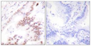 Immunohistochemical analysis of paraffin-embedded human lung carcinoma tissue using Anti-p300 Antibody. The right hand panel represents a negative control, where the antibody was pre-incubated with the immunising peptide