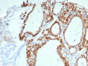 Immunohistochemical analysis of formalin-fixed, paraffin-embedded human thyroid using Anti-Cadherin 16 Antibody [CDH16/7027R] at 2 µg/ml in PBS for 30 minutes at room temperature Inset: PBS instead of the primary antibody Secondary antibody negative control