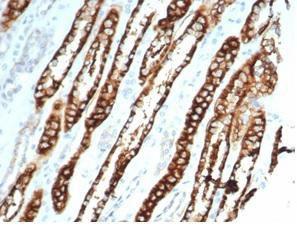 Immunohistochemical analysis of formalin-fixed, paraffin-embedded human renal cell carcinoma using Anti-Cadherin 16 Antibody [CDH16/7027R] at 2 µg/ml in PBS for 30 minutes at room temperature