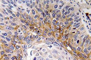 Immunohistochemical analysis of paraffin-embedded human lung carcinoma tissue using Anti-Cardiotrophin-1 Antibody