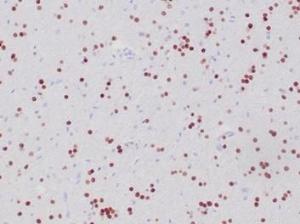 Immunohistochemical analysis of formalin-fixed, paraffin-embedded human oligodendroglioma tissue using Anti-OLIG2 Antibody [OLIG2/6695R]